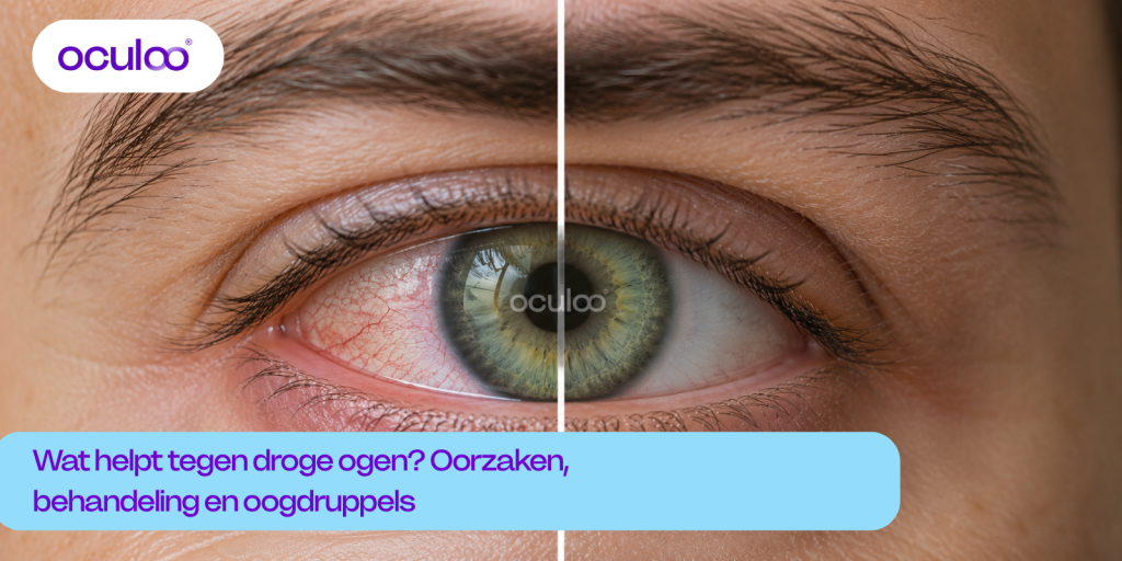 Groen oog met links zichtbare roodheid door droge ogen en rechts een rustiger oog