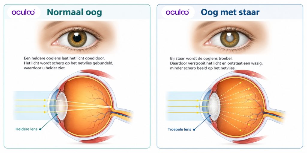Verschil tussen een normaal oog en een oog met staar