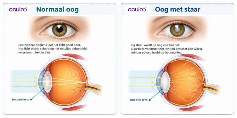Verschil tussen een normaal oog en een oog met staar